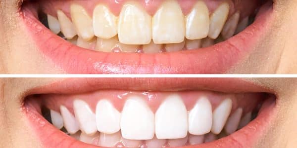 Close-up of a patient's mouth before and after they got professional teeth whitening treatment.