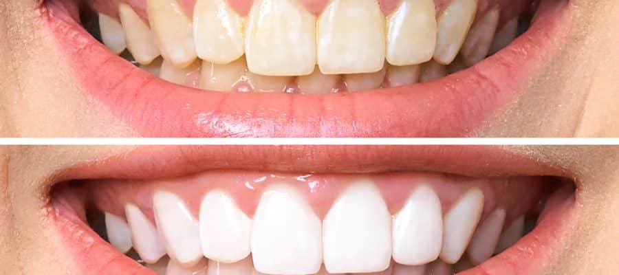 Close-up of a patient's mouth before and after they got professional teeth whitening treatment.